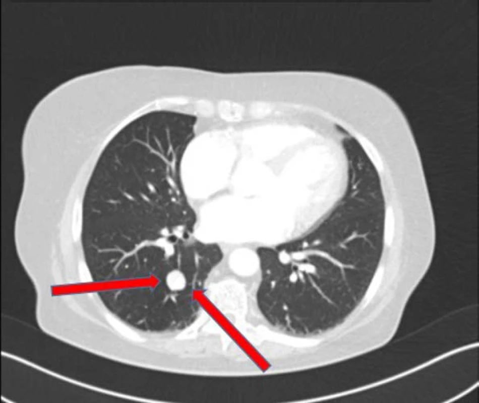 Metastáza v plicích při
restaging dle CT vyšetření z druhé poloviny
července 2017<br>
Fig. 4. Metastasis in lungs in restaging –
CT July, 2017