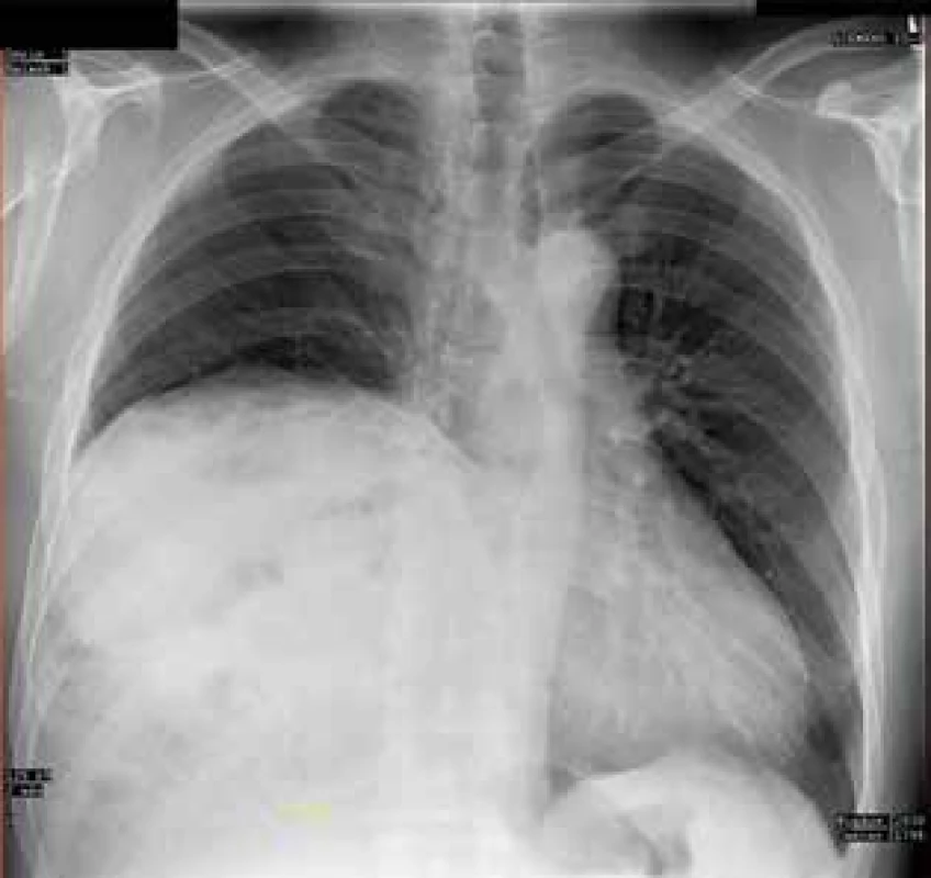 Předoperační RTG hrudníku, kde nález imitoval
parézu bránice<br>
Fig. 2: Preoperative chest X-ray where the finding imitated diaphragmatic paresis 