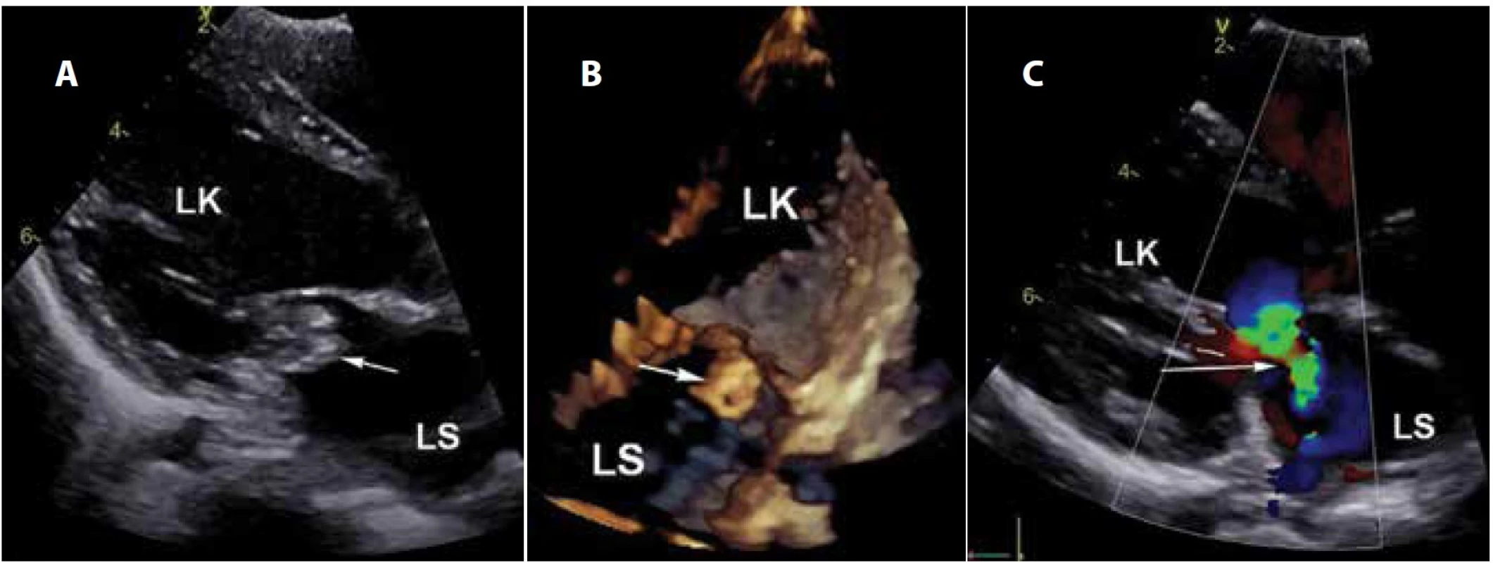 Echokardiografie: a) vegetace na mitrální chlopni, 2D obraz, dlouhá osa levé komory; b) vegetace v obraze 4D, čtyřdutinová
projekce; c) významná regurgitace chlopně, barevné dopplerovské zobrazení (LS: levá síň, LK: levá komora).
Fig. 1. Echocardiography: a) the mitral valve vegetation, 2D image, long axis of the left ventricle; b) vegetation in 4D image, fourchamber
scan; c) significant regurgitation of the valve, Doppler colour flow mapping (LS: left atrium, LK: left ventricle).