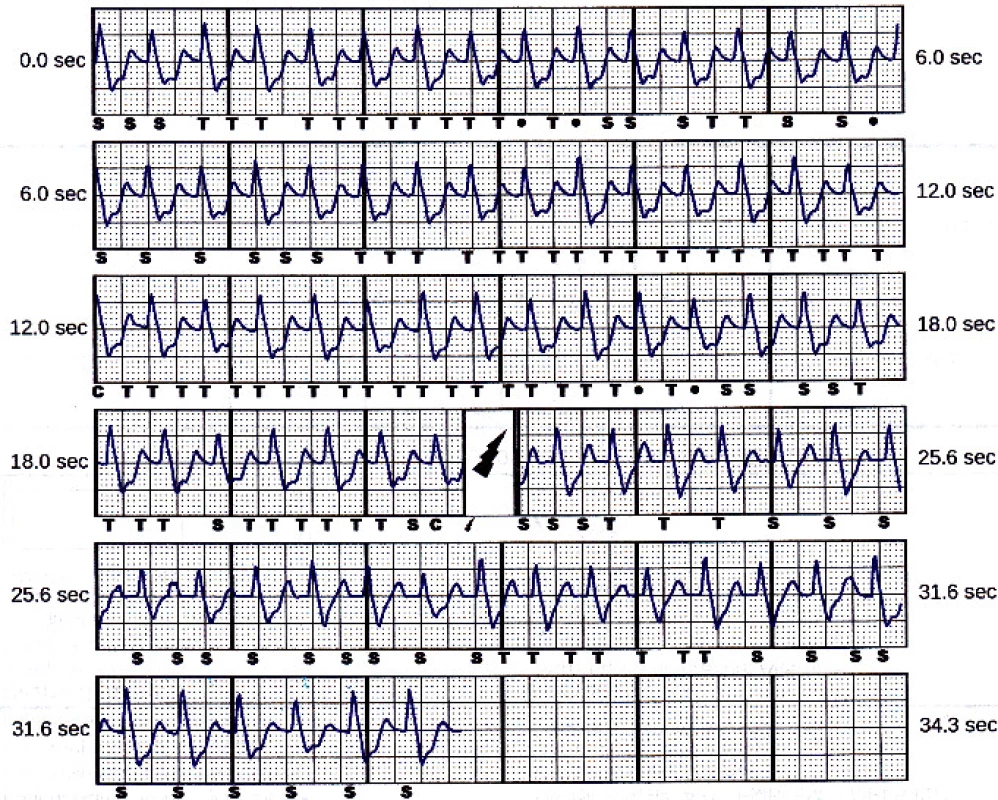 Treated episode saved in the device memory.
Beats marked “S” are sensed (below the tachycardia
detection zone), beats marked “T” are in tachycardia
zone, “C” means charge started. The symbol of flash
stands for the delivered shock.