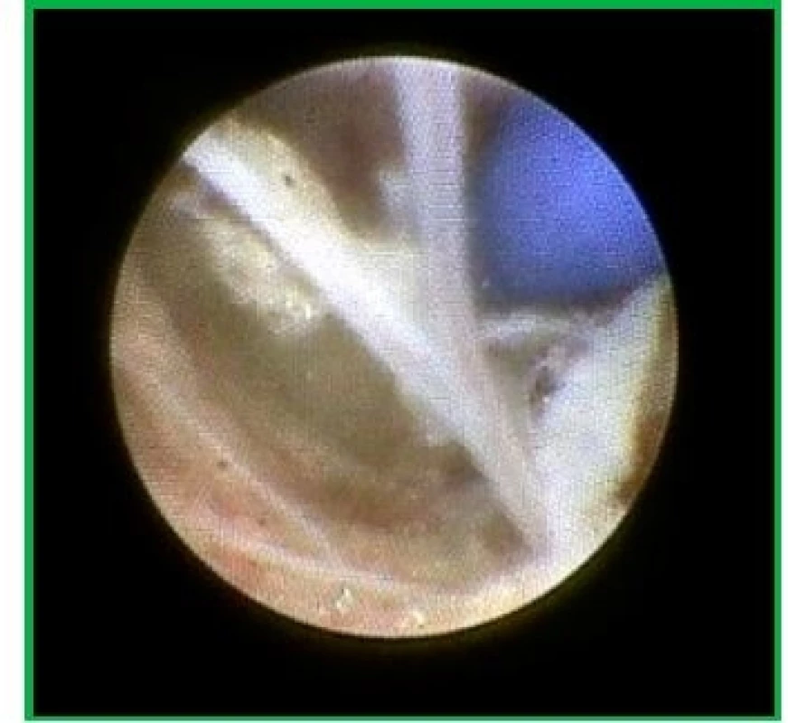 CT – roztažení balónku (modré barvy) přídatného modulu s cílem rozrušit fibrózní srůsty a oddálit je od nervového kořene