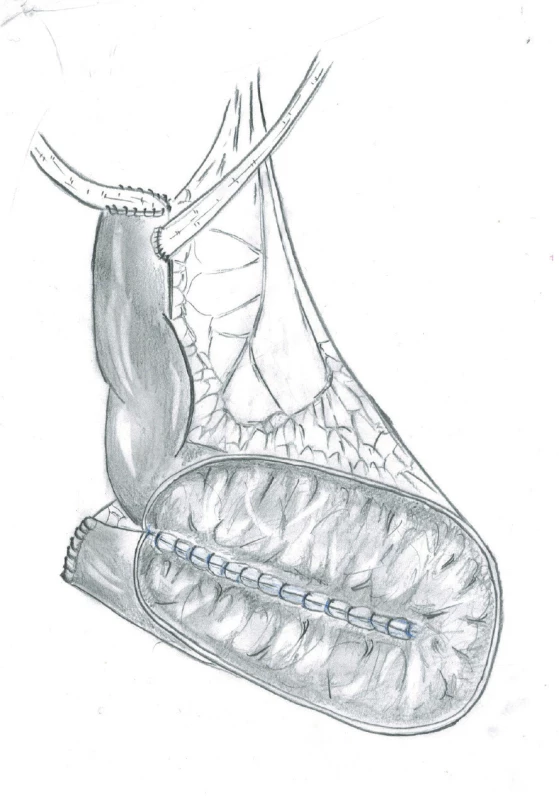 Ileální neovezika otevřena v původní sutuře<br>
Fig. 2. The ileal neobladder was opened in the line of
previous suture