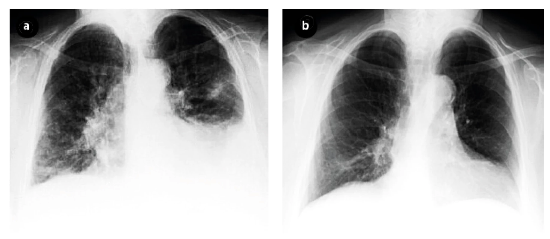 Chest X-Ray before (Figure 2a) and after (Figure 2b) treatment