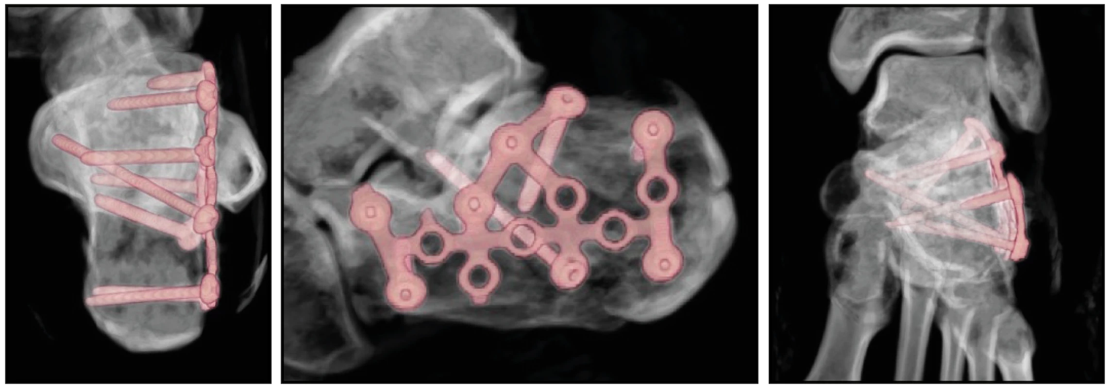 Pooperační VRT obrazy po osteosyntéze zlomeniny patní kosti dlahovou osteosyntézou