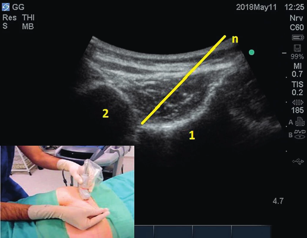 Aplikace k sakroiliakálnímu skloubení pod
ultrazvukovou kontrolou. 1 – kost křížová, 2 – kost kyčelní, 3 –
skloubení, n – jehla