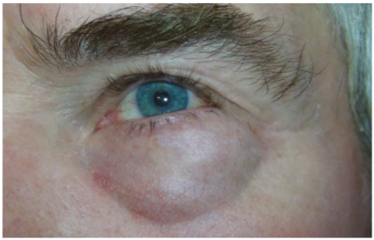 Patient 2 – tumour of left lower eyelid