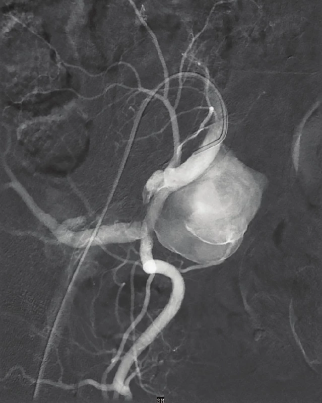 Digitální subtrakční angiografie – vak aneuryzmatu
v odstupu a.glutea superior<br>
Fig. 2: Digital subtraction angiography – hypogastric artery
aneurysm on the level of the superior gluteal artery
