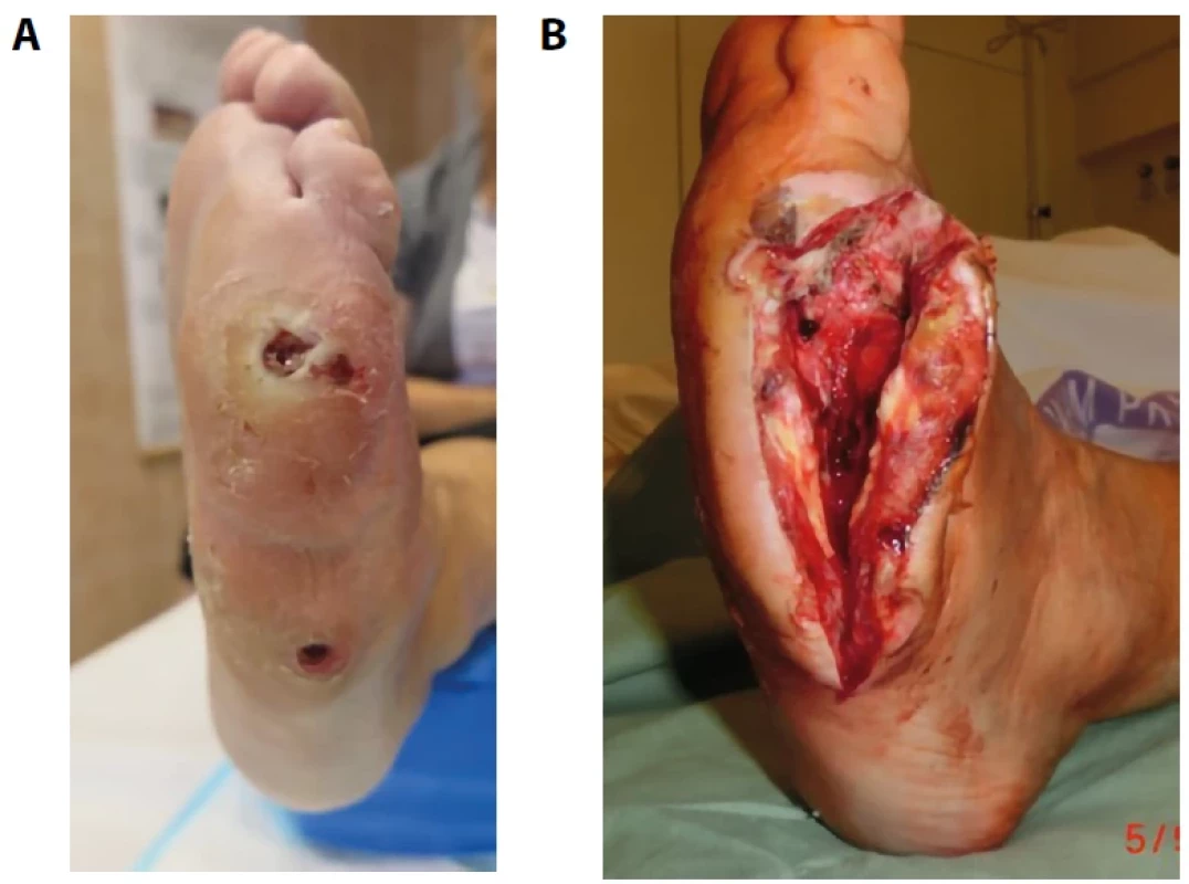 Závažná infekce v rámci syndromu diabetické nohy; klinický obraz před chirurgickým zákrokem (A) a po něm (B)