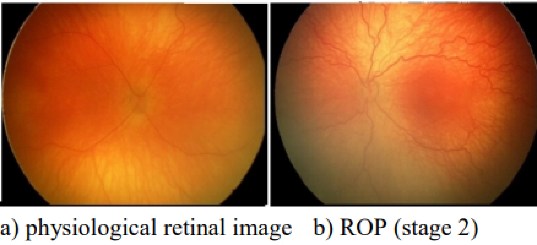  a) Retinal image with physiological blood
vessels, b) retinal image with ROP (stage 2) with
tortuosity