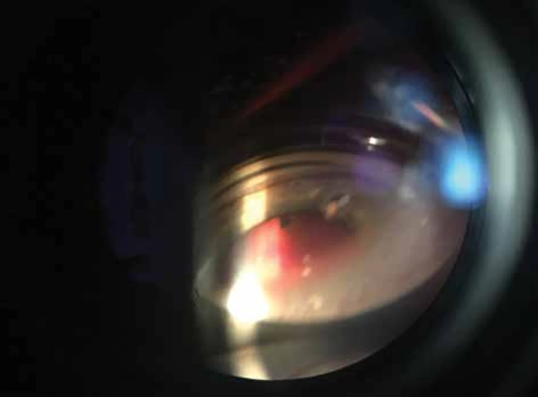 Určení aktuální pozice nitroočního cizího tělesa nepřímým oftalmoskopem