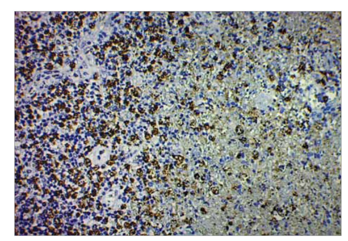 Obraz nekrózy imunohistochemickou metódou CD-68
(zväčšenie pri obj. 10).<br>
Fig. 6. Image of necrosis by immunohistochemical method CD-68
(magnification at volume 10).