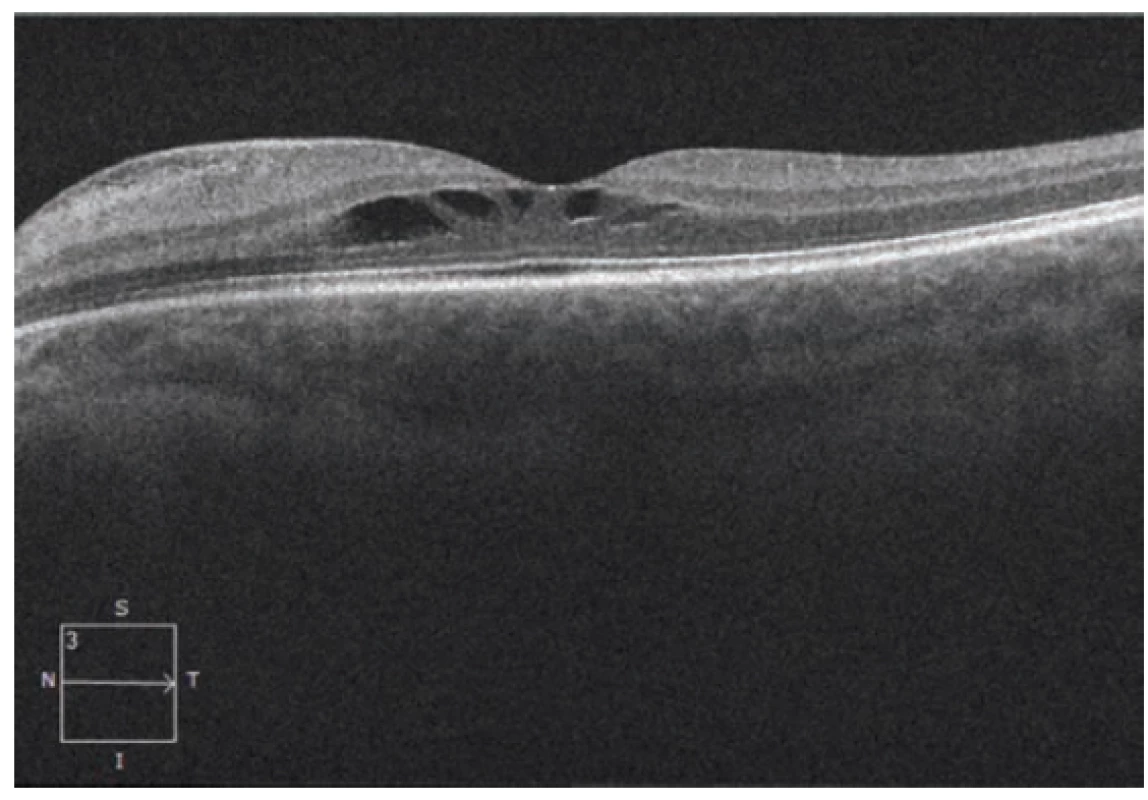 HD-OCT: Lineární horizontální transfoveolární
sken levého oka, kontrola po 4 měsících, obraz stacionární
schisis-like makulopatie