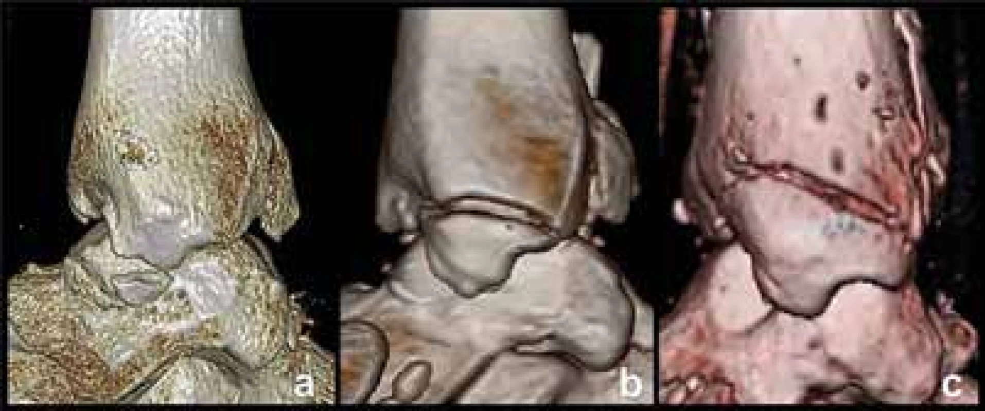 Klasifikace zlomenin mediálního kotníku na 3D CT rekonstrukcích
a – typ 1, zlomenina colliculus anterior, b – typ 2, zlomenina colliculus anterior
a sulcus intercollicularis, c – typ 3, zlomenina obou kolikulů.<br>
Fig. 4. Classification of medial malleolus fractures based on 3D CT reconstructions:
a – type 1, fracture of the anterior colliculus; b – type 2, fracture of the anterior
colliculus and intercollicular groove; c – type 3, fracture of both colliculi.