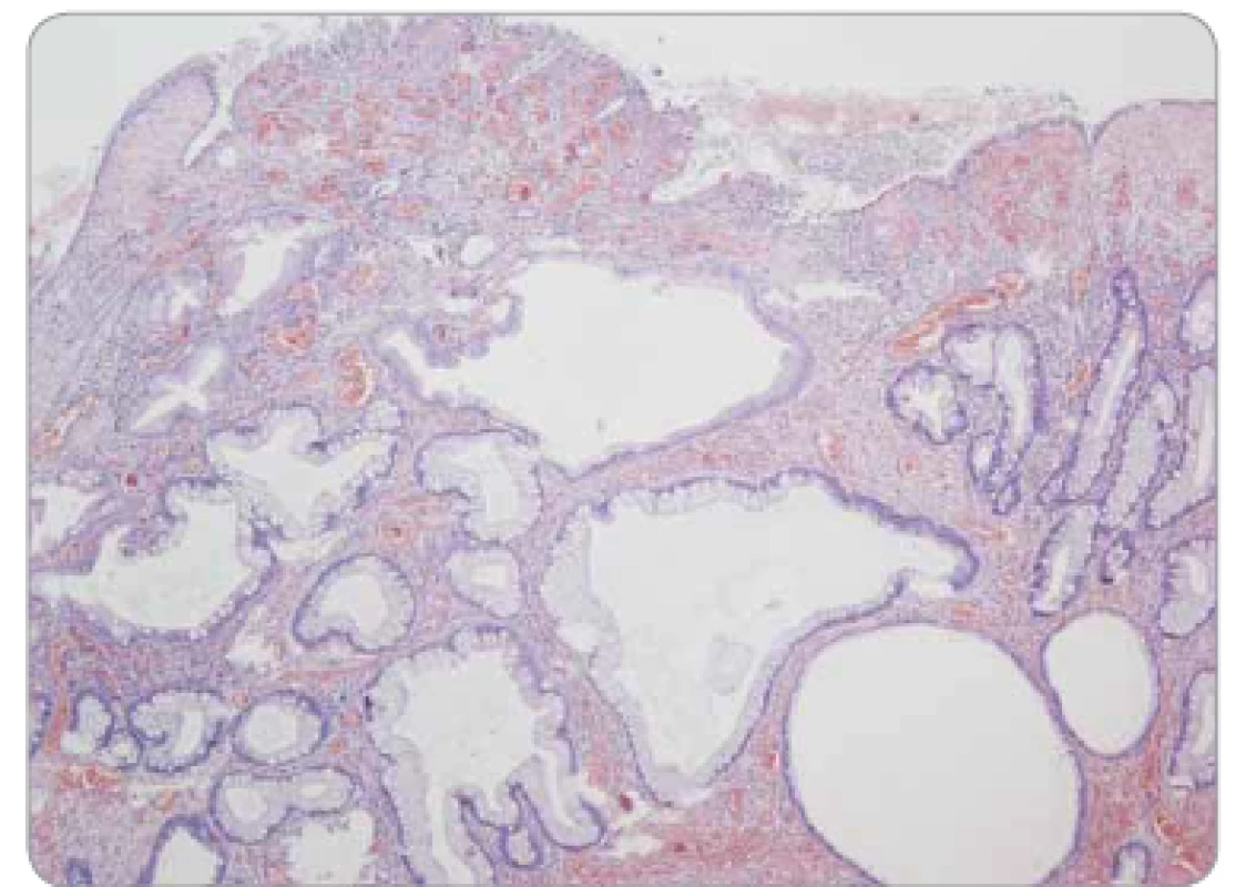 Juvenilní polyp tračníku – povrchová eroze, edematózní
proprie se zánětlivou infi ltrací, mikrocysty s výstelkou tvořenou
normálními enterocyty a pohárkovými buňkami sliznice colon,
bez dysplazie.