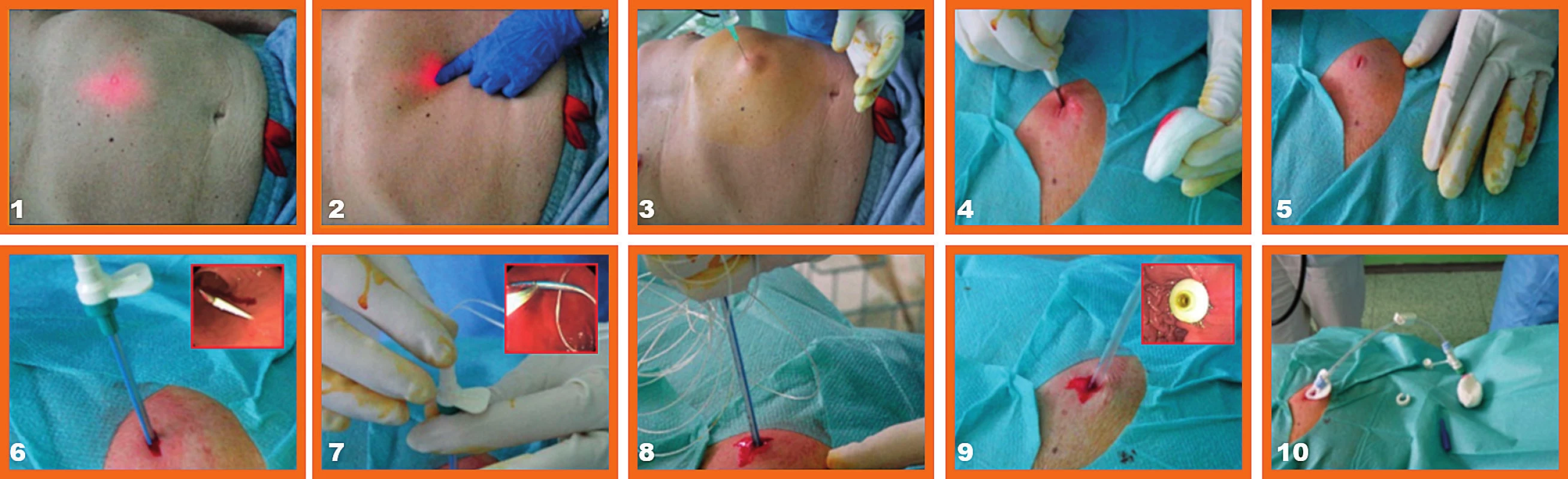 Schematický obrázok perkutánnej endoskopickej gastrostómie (Endoskopická ambulancia III. Internej kliniky LF UK a UNB v Bratislave) <br>1 – transiluminácia, 2 – digitálne potvrdenie transiluminácie, 3 – lokálne aplikovaná analgézia 1% Mesocainom, 4 – skalpelom realizovaná kožná incízia, 5 – kožná incízia, 6 – kožnou incíziou zavedená punkčná ihla aj so zavádzačom, pohľad zvnútra na hrot ihly, 7 – cez zavádzač zavedené ťažné vlákno do žalúdka, pohľad do žalúdka, kde je vlákno zachytené slučkou a vyvedené ústami von, 8 – ťahom čiže „pull“ metódou vyvedená PEG sonda cez brušnú stenu, 9 – vyvedená PEG sonda, pohľad z vnútra na fixačnú platničku PEG-u, 10 – pohľad na zavedenú PEG sondu
