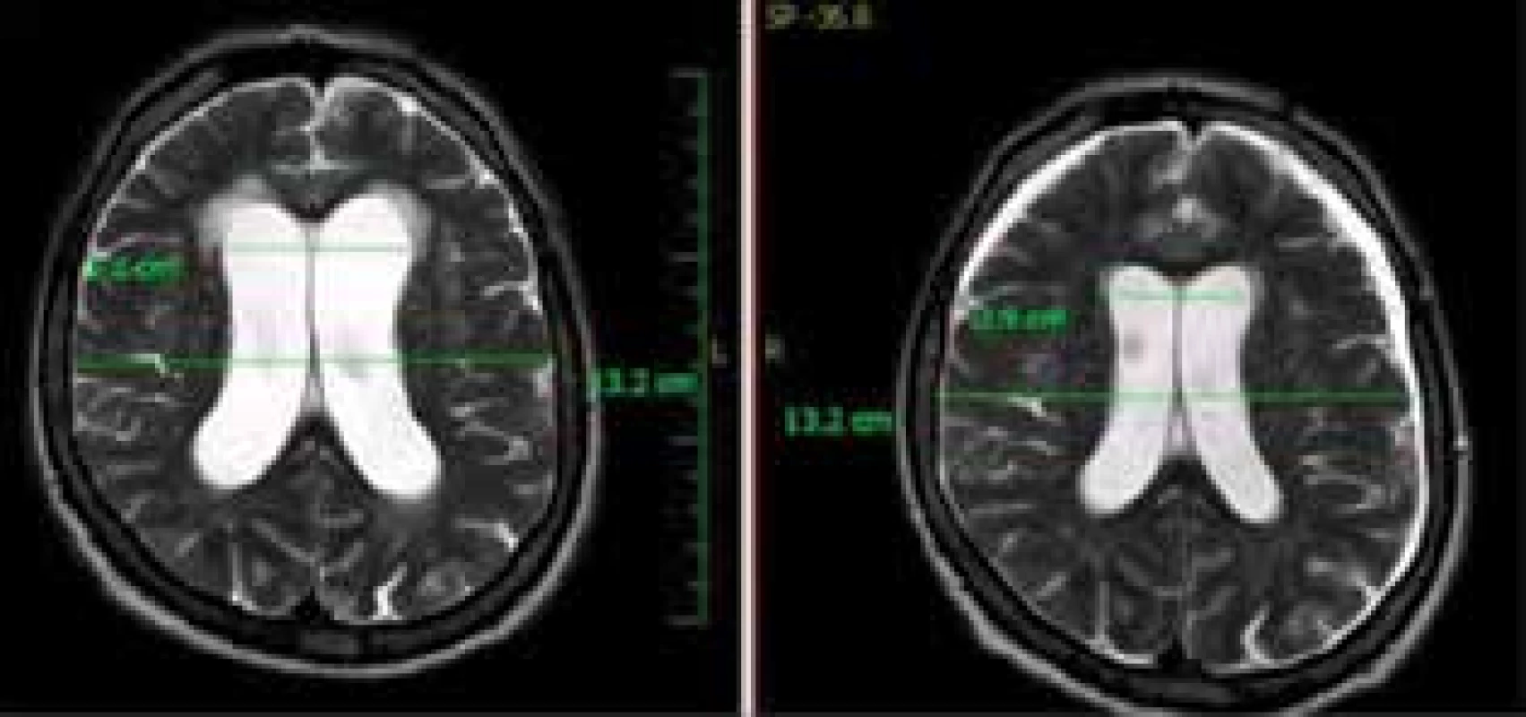 Vpravo MR snímek pacienta po kraniotraumatu
s oboustranným akutním subdurálním hematomem
frontálně oboustranně, vlevo MR snímek u téhož
pacienta s měsíčním odstupem, kde již vidíme rozšíření
postranních komor s transependymálním prosakem
a počínajícím setřením subarachnoideálních prostor<br>
Fig. 5: MR picture on the right showing a patient after
craniotrauma, bilateral acute subdural hematoma can
be seen. The picture on the left shows the same patient
one month later. Enlargement of the lateral ventricles
with transependymal edema and incipient subarachnoid
space effacement can be seen.
