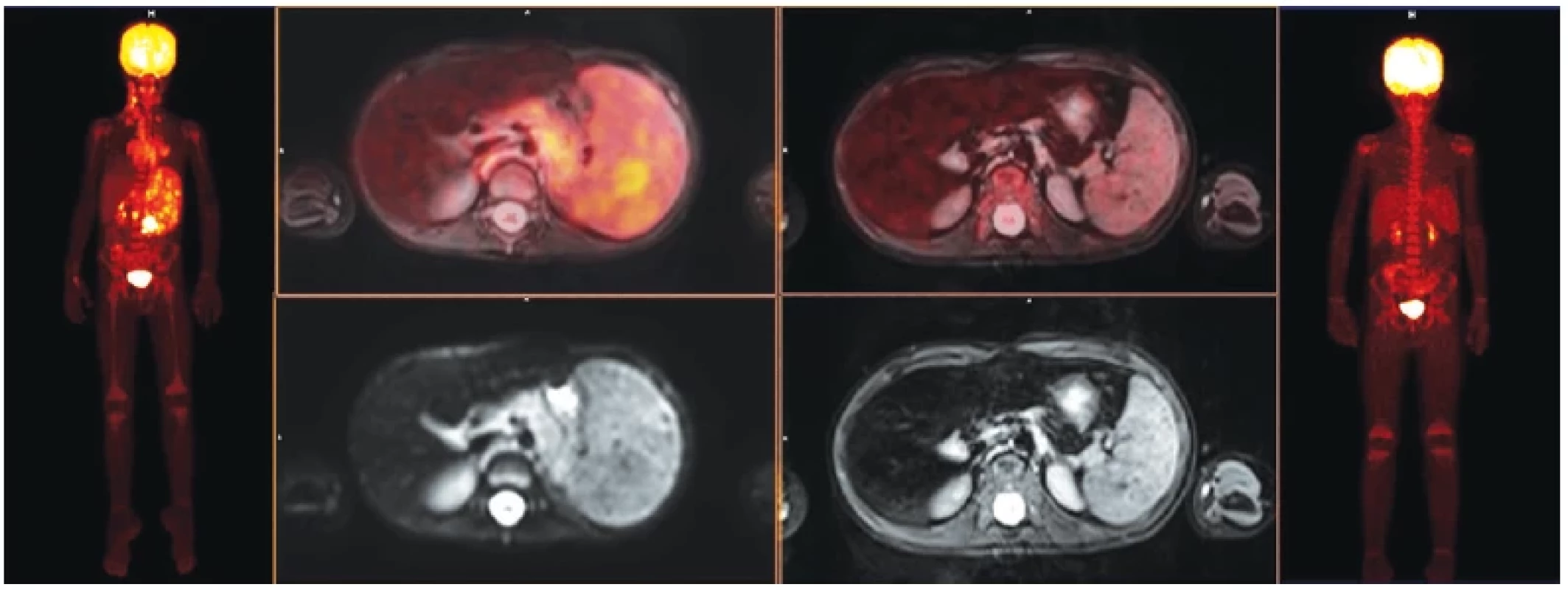 Šestiletý chlapec s Hodgkinovým lymfomem, vyšetření s podáním 18F-FDG, vlevo zobrazení před zahájením léčby, celotělový PET
obraz, fúze PET/MRI a T2 vážený obraz, vpravo interim vyšetření s kompletním ústupem metabolického postižení – hodnocení nálezu je
Deauville skóre 1