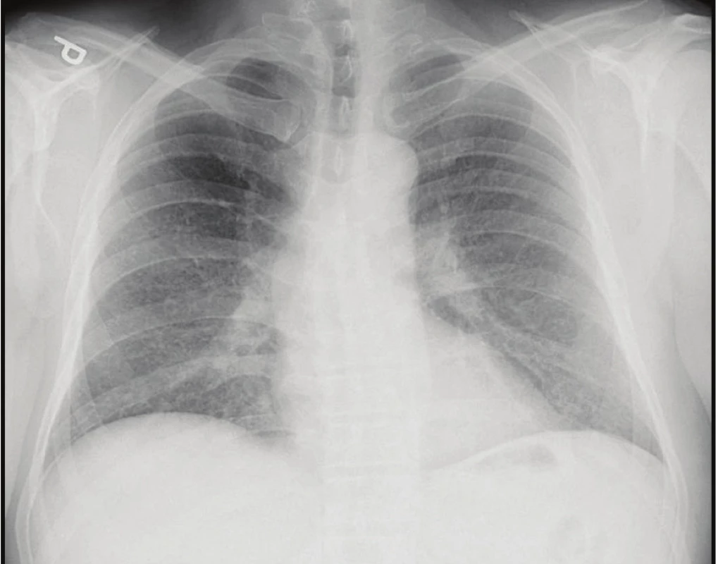 Skiagram hrudníku: mnohočetná drobná
nodulární zastínění<br>
Fig. 1. Chest X-ray: small and multiple pulmonary
miliary nodules