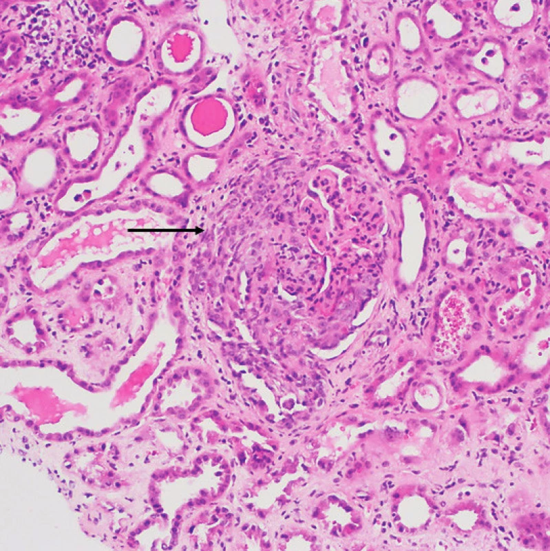 Granulomatóza s polyangiitidou s postižením ledvin:
glomerulus s nekrózou postihující více než 50 % kapilárního trsu
a objemným celulárním srpkem (šipka). Okolní tubuly s oploštělou
výstelkou a projevy ischemie, tj. s akutní tubulární nekrózou (barvení
HE, zvětšení 200×) (Ústav klinické a molekulární patologie LF
UP a FN, Olomouc)