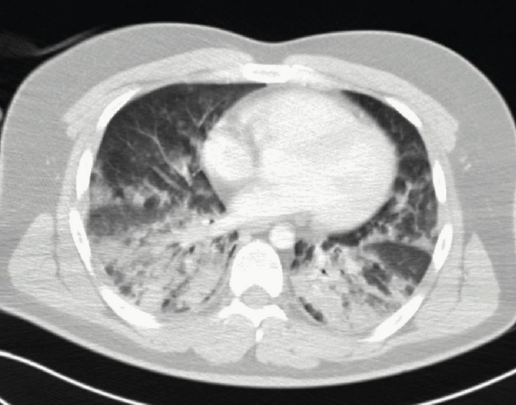 CT plic pacienta z kazuistiky 1