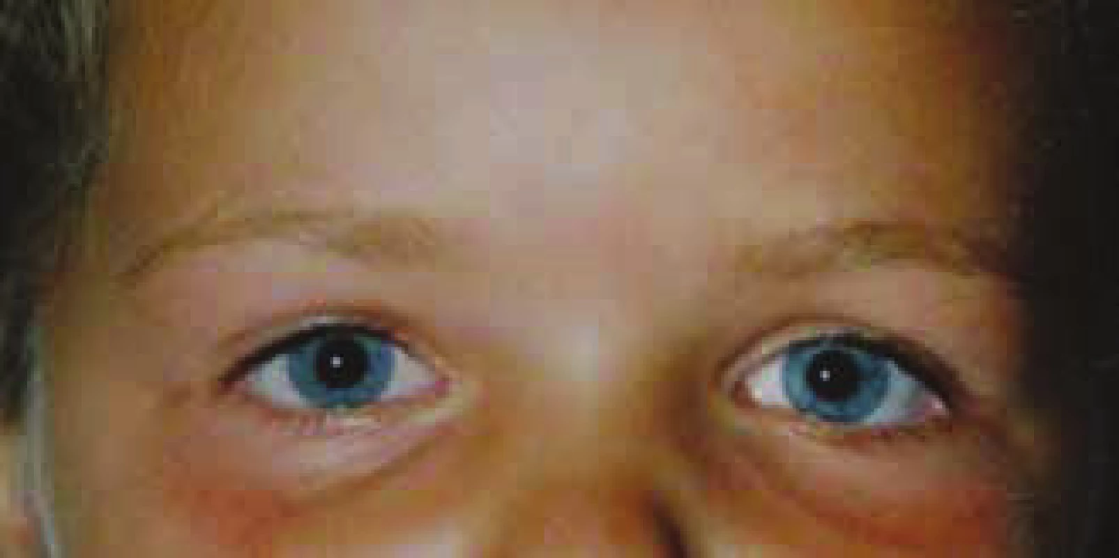 Normalisation of left pupil width at follow-up examination
of patient on second day