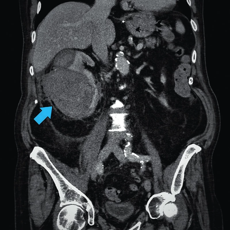 Pooperační komplikace – CT obraz subkapsulární
hematom pravé ledviny tři měsíce po robotické resekci pravé
ledviny