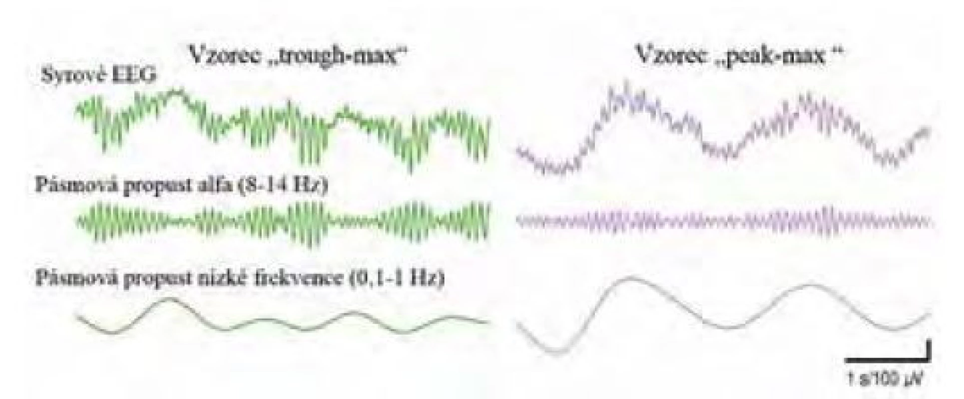 Dva odlišné vzorce vazby mezi fází a amplitudou (phase-amplitude
coupling). Vzorec „peak-max“ odpovídá chirurgické anestezii, amplituda
alfa oscilací je nejvyšší na vrcholech pomalých oscilací, kdežto „trough-max“,
u něhož je amplituda alfa oscilací nejvyšší v údolích pomalých oscilací, znamená
příliš mělkou, nebo naopak příliš hlubokou anestezii. Upraveno z [38]