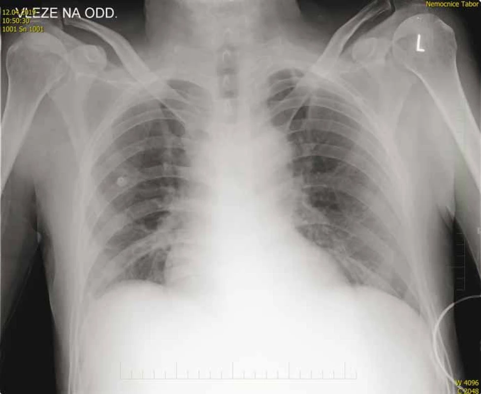 Vstupní RTG snímek hrudníku – normální nález.<br>
Fig. 1. Input chest X-ray – normal finding.