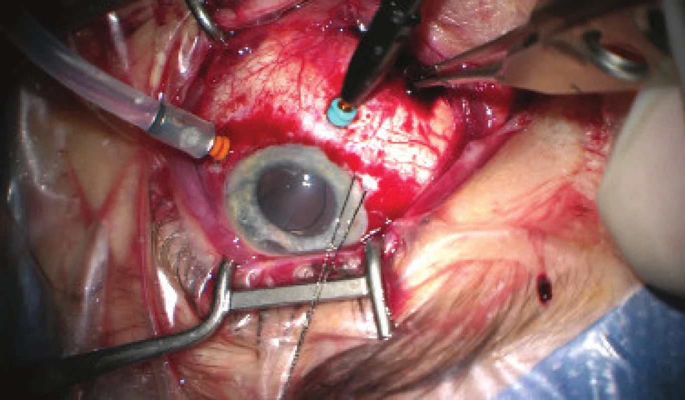 Progressive evacuation of blood from second sclerotomy
(forceps inserted into wound), after disappearance
of ablation behind IOL 23G infusion inserted in region of
pars plicata (orange port) and 25G light (Chandelier, blue
port) for monitoring of the ocular fundus with display system
of microscope (Zeiss Resight). Auxiliary traction suture
inserted into the region of limbus in no. 8, evident decentration
of IOL. Image from perioperative video – from surgeon’s
view