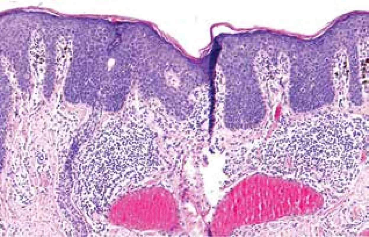Histologický nález – rozšířená epidermis, mitózy a atypické
mitózy keratinocytů ve všech úrovních str. Malpighi, hyperchromazie
a pleomorfismus jader keratinocytů<br>
Melanin v keratinocytech a melanofázích, lymfocytární infiltrát
v koriu.