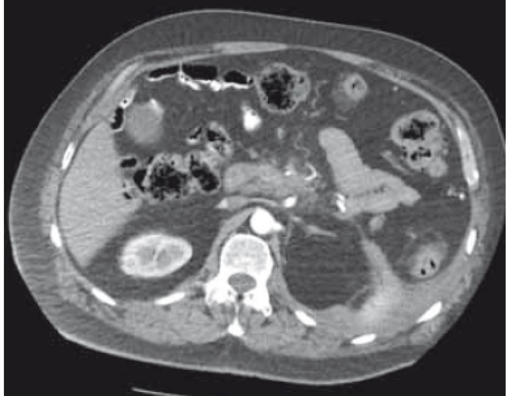 CT břicha – kompletní regrese
ohraničené pankreatické nekrózy po
endoskopické drenáži.<br>
Fig. 7. Abdomen CT – complete regression
of walled-off pancreatic necrosis
after endoscopic drainage.