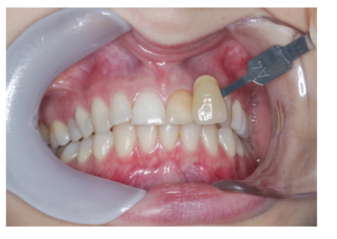 Zub zafarbený
zinkoxideugenolovým
sealerom<br>
Fig. 1
Tooth discolored
by zinc-oxide eugenol based
sealer