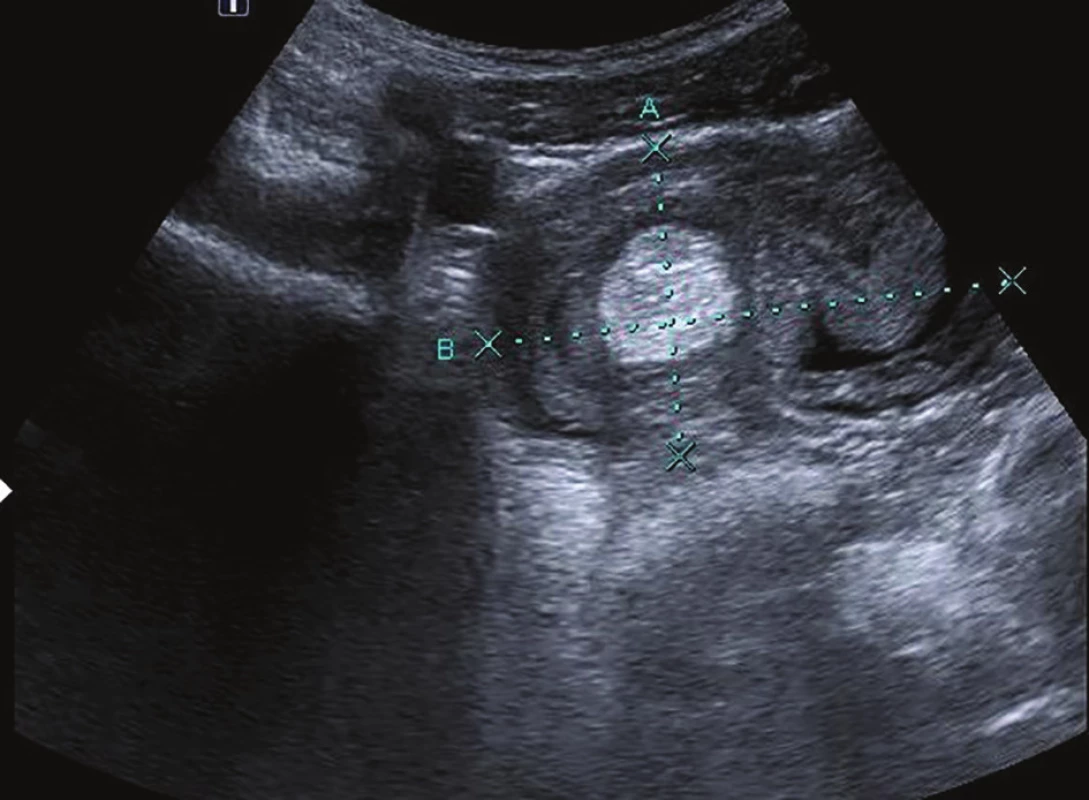 Abdominal USG with a target-like mass – intussusception
(transverse section, axis A= 4.2 cm, axis B=7.2
cm), hyperechogenic polypoid structure intraluminally