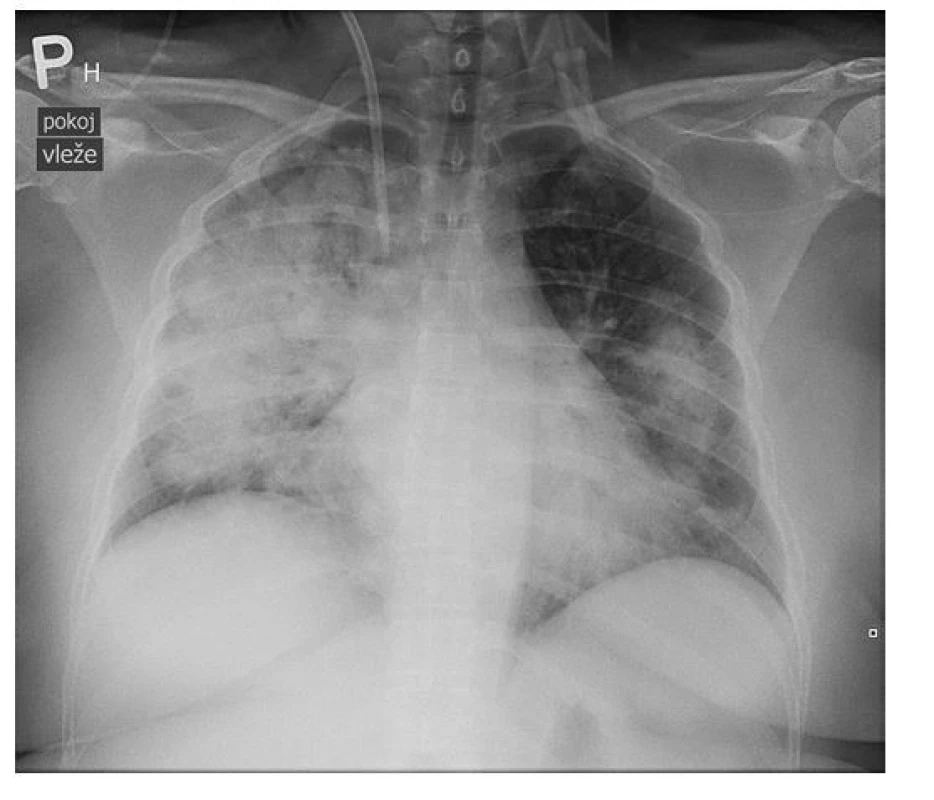 Radiografické vyšetření plic pacientky s nálezem masivní bilaterální
infiltrace (archiv autorky a Kliniky radiologie FN Olomouc)