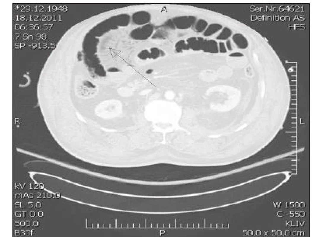 CT nález při rozvinutém ACS – mezikličkový hematom, výrazná
distenze kliček, obraz střevní paralýzy, vzduch ve stěně střevní a v žilním
systému mezenteria