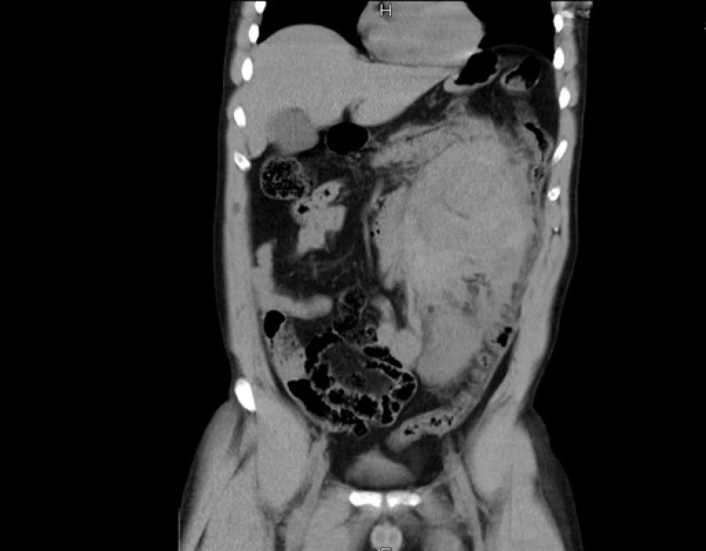 Nativní CT vyšetření břicha a retroperitonea
před operační revizí. Na snímku patrný objemný
hematom vlevo (v tabulce pacient číslo 5,
kdy pro urgentnost stavu a manifestní šok nebylo
možno kontrastní vyšetření doplnit a indikována
urgentní operační revize)<br>
Fig. 1. Unenhanced CT scan of the abdomen
and retroperi¬toneum prior to surgical revision.
The image shows a voluminous haematoma
on the left (patient 5 in the table in whom the
urgency of the condition and manifest shock
did not allow for a contrast scan to be taken,
and urgent surgical revision was indicated)