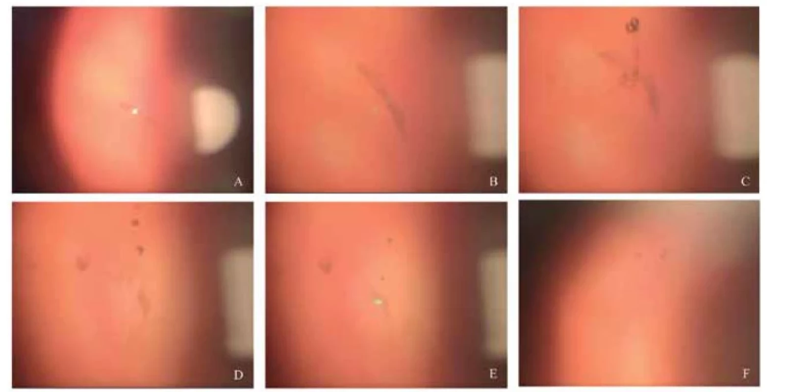 Průběh laserové vitreolýzy u non PVD typu zákalu. (A) opacita (B) opacita zvětšení 16x (C, D, E) redukce opacity
v průběhu zákroku (F) Foto na konci zákroku<br>
PVD–posterior vitreous detachment