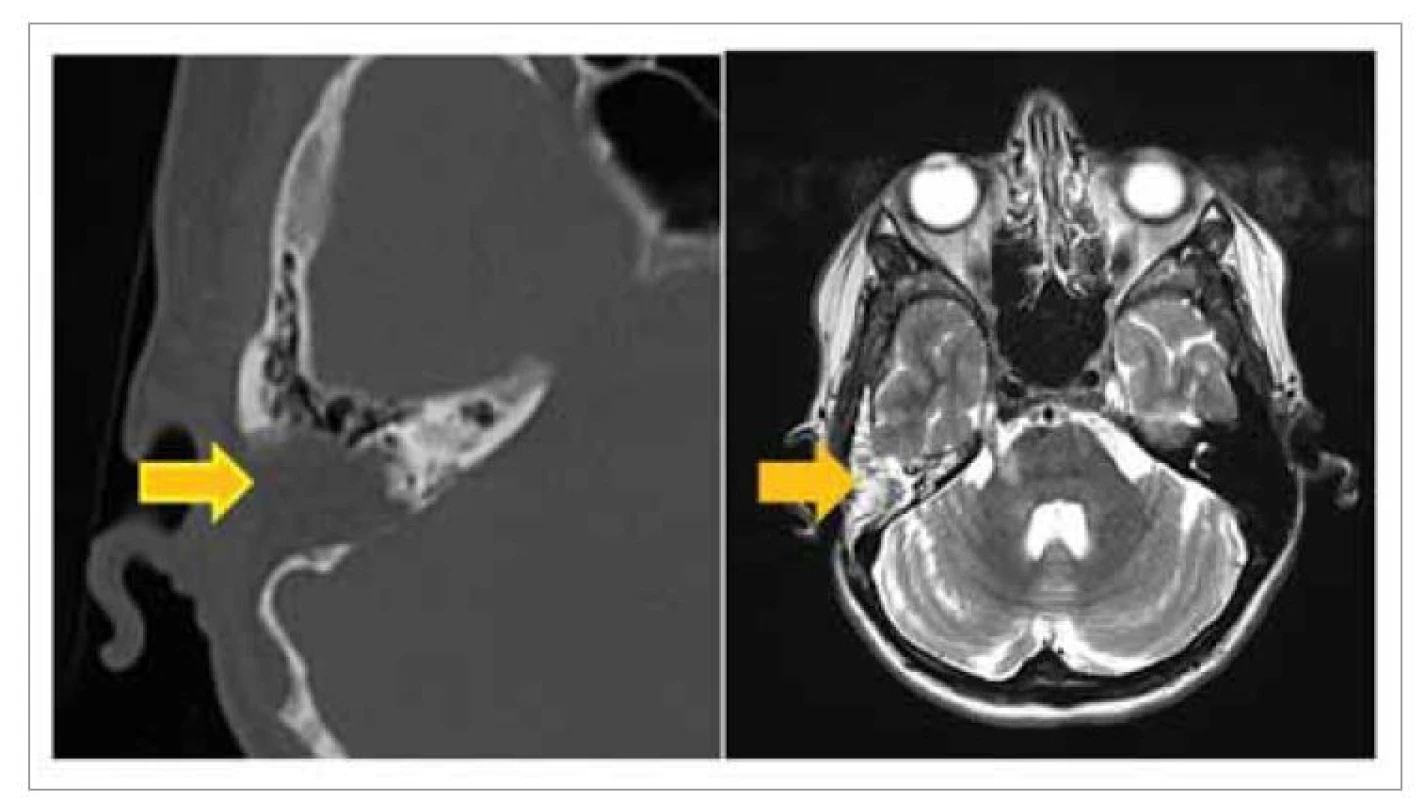 Kontrolné CT a MR vyšetrenie po subtotálnej petrosektómii – žltá šípka
ukazuje trepanačnú dutinu obliterovanú tukom.<br>
Fig. 5. Control CT and MRI after subtotal petrosectomy – yellow arrow shows
trepanation cavity obliterated with fat.