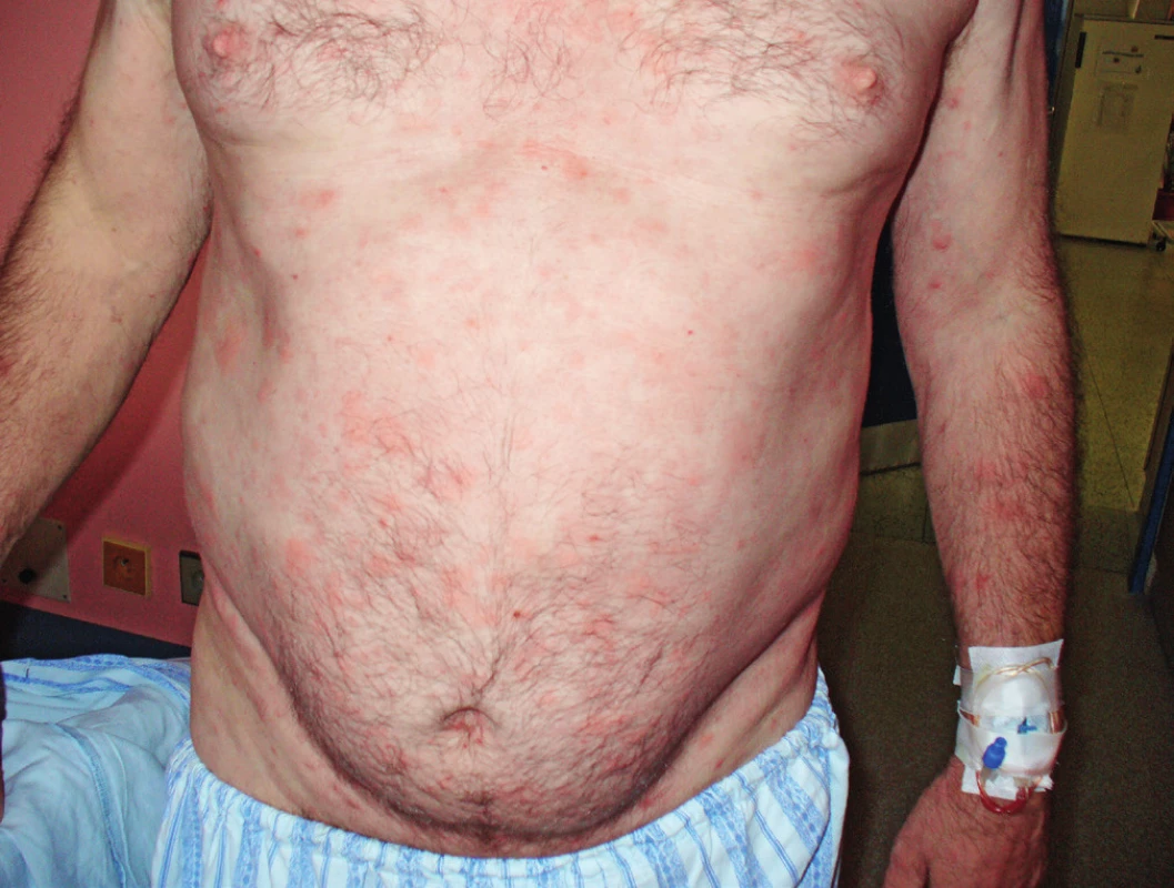 Snímek prvního pacienta s velkými kopřivkovými morfami před léčbou anakinrou