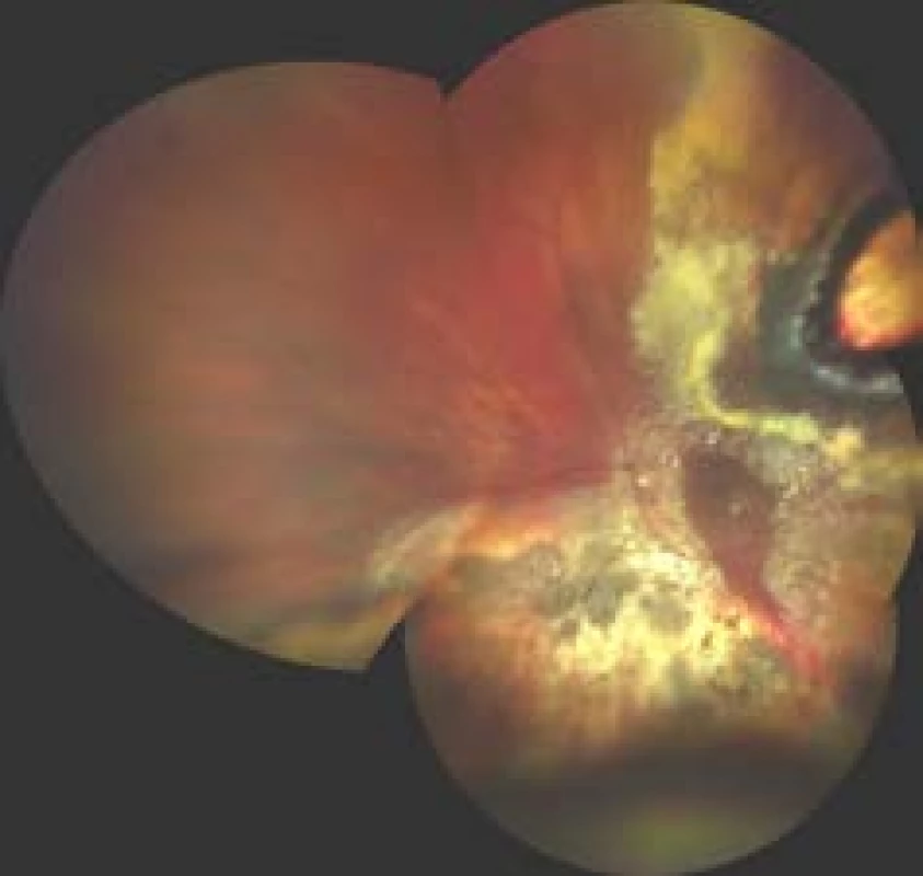Finding on fundus 3 months after endoresection of melanoma following prior therapy by LGK