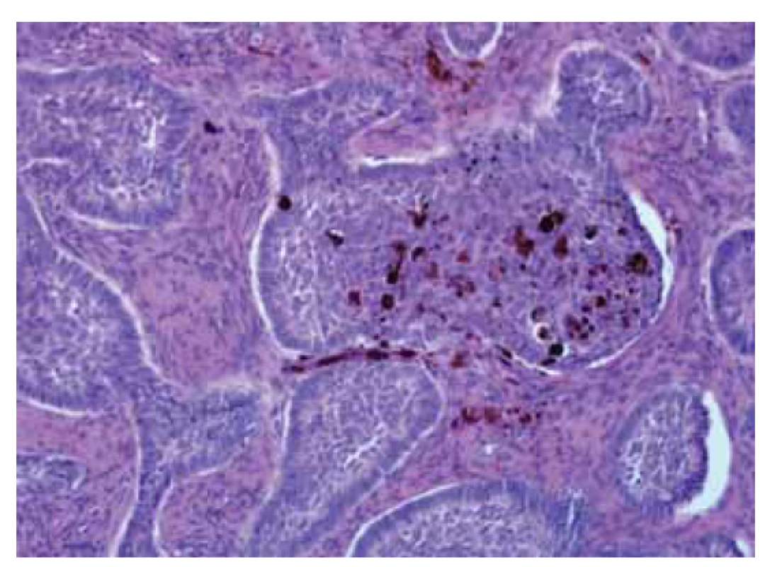 Pigmentovaný bazocelulární karcinom.<br>
Fig. 9. Pigmented basal cell carcinoma.