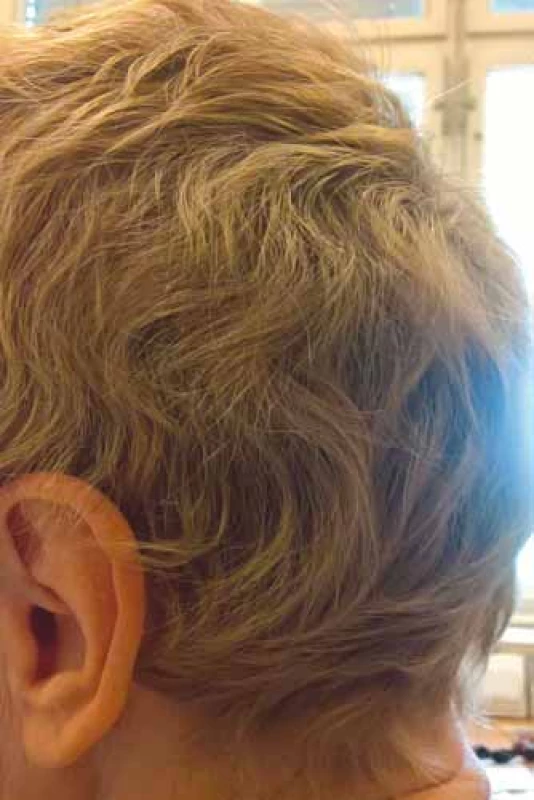 Změna kvality vlasů po chemoterapii
– kudrnatost (foto H. Jedličková).