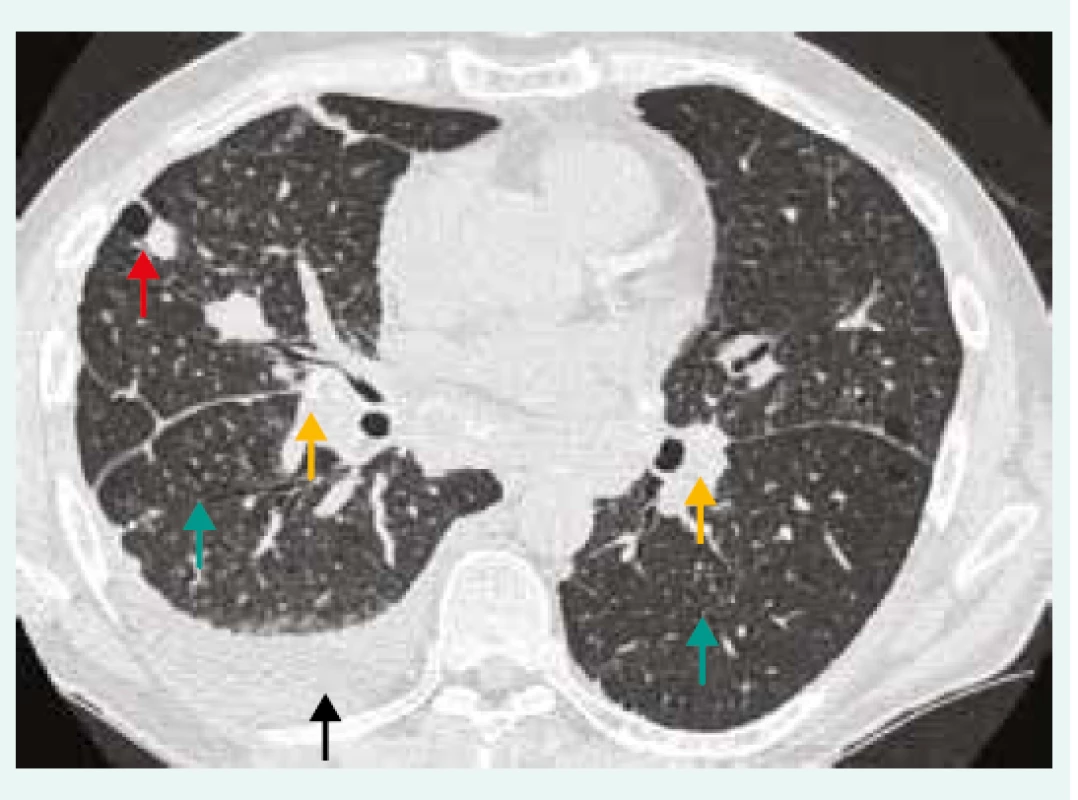HRCT hrudníku pacienta se silikózou, pneumonií
s pleurální reakcí a podezřením na CD4+
lymfocytopenie. Oboustranná lymfadenopatie
s kalcifikacemi (žlutá šipka), bronchioloektazie/
bronchiektazie (zelená šipka), nodularity
(červená šipka), pleurální výpotek (černá šipka).<br>
Z archivu autorky