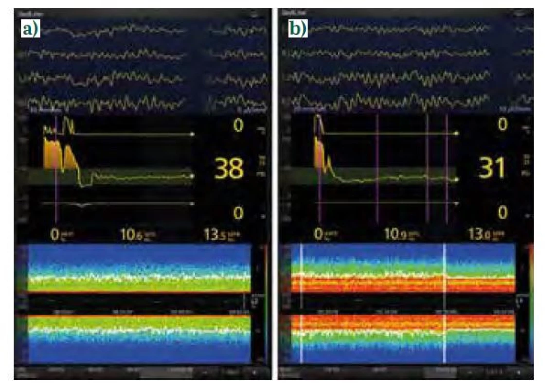 EEG křivky a spektrogramy anestezie sevofluranem (úvod propofolem,
sufentanil). a) muž, 72 let, plastika a. femoralis, mělčí doplňovaná
anestezie, PSI 38 (není na obrázku), MAC neuvedena, na spektrogramu jsou
patrné výrazné oscilace v pásmech SW-δ (< 4 Hz) a α (8-12 Hz), hodnoty
SEF95 do 15 Hz svědčí o dostatečné antinocicepci, b) žena, 69 let, aorto-ilický
bypass, doplňovaná anestezie, PSI 31, MAC korigovaná k věku 0,9 (není na
obrázku), na spektrogramu jsou patrné výrazné oscilace v pásmech SW-δ
(< 4 Hz), θ (4-7 Hz) i α (8-12 Hz), tj. fenomén fill-in, SEF95 poněkud kolísá,
proto ještě přidán sufentanil 25 μg i. v. (označeno druhou svislou bílou linií),
antinocicepce posílena
