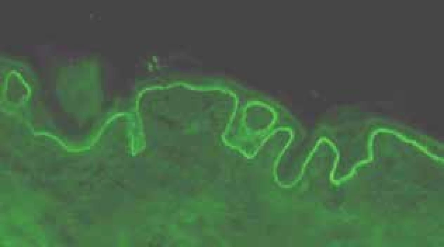 Přímá imunofluorescence - IgA lineární depozita podél
bazální membrány