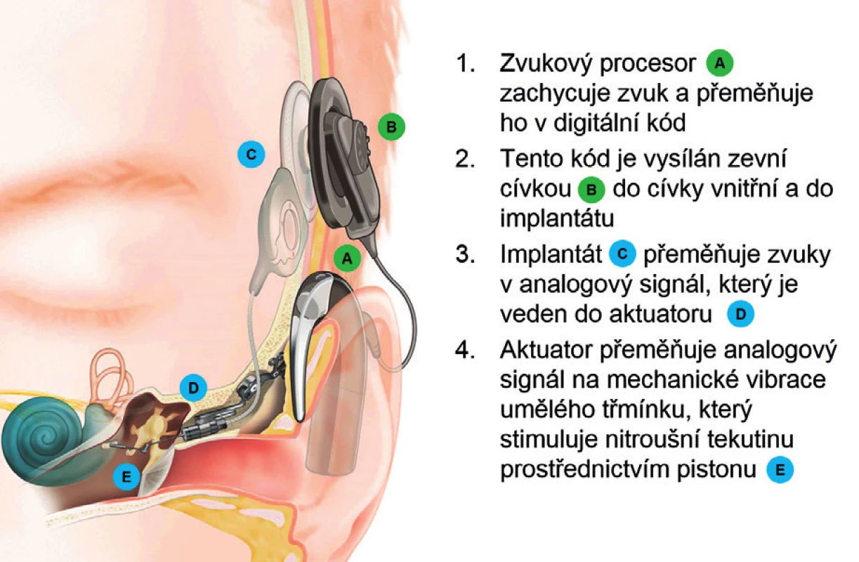 Schéma aktivního středoušního implantátu Codacs®
(Cochlear Ltd, Sydney, Austrálie). Přímý akustický kochleární
implantát přenáší vibrace přímo do nitroušní tekutiny.
(Zdroj: Cochlear Ltd, Sydney, Austrálie.)