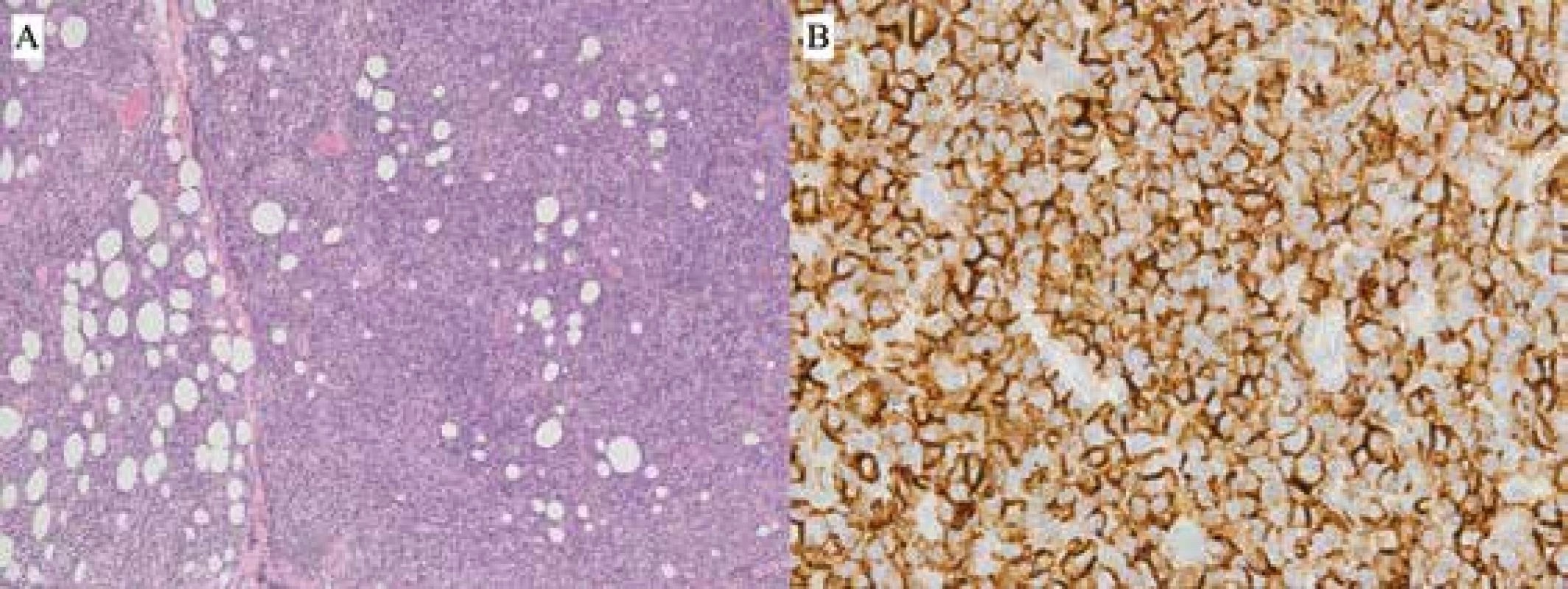 Pacient 2 – B-NHL zo spektra MZBL typu MALT, bioptický nález: <br>A) Infiltrácia fibrolipomatózneho spojiva denznou, difúzne rastúcou nádorovou lymfoproliferáciou z malých až stredne veľkých lymfoidných buniek (HE, zv. 100x) <br>B) Imunohistochemická pozitivita znaku CD20+ v nádorových bunkách (zv. 630x)