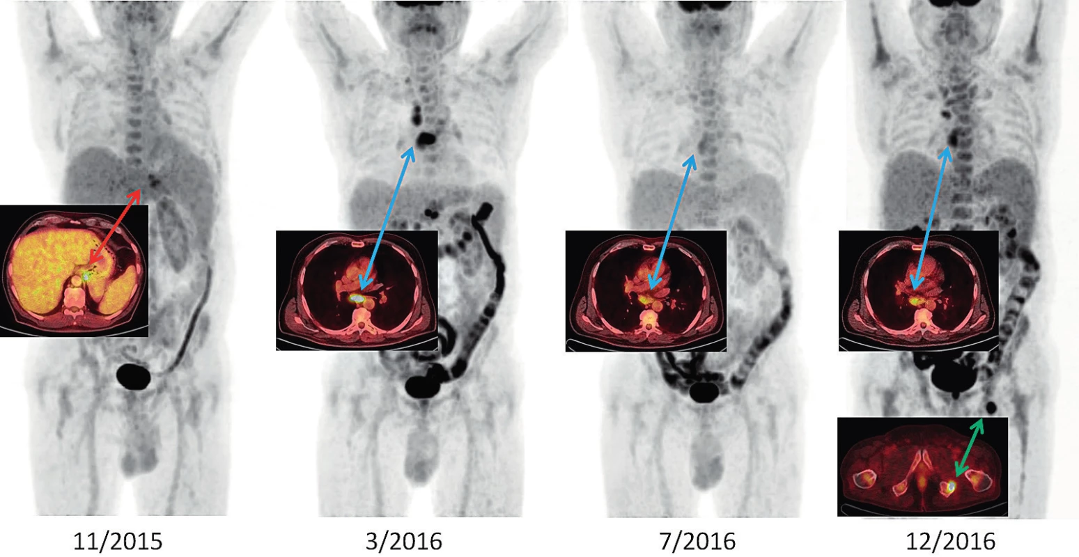 Vývoj Stillovy nemoci v období 11/2015–12/2016 v PET/CT zobrazení u našeho pacienta<br>
11/2015: metabolicky aktivní lymfadenopatie při kardii a u levého bráničního crus (SUVmax 6,1), lehce pozitivní nález v retroperitoneu a v kostní dřeni<br>
3/2016: rozvinutý nález, lymfadenopatie za pravou klíční kostí, v mediastinu SUVmax 10,1; v retroperitoneu SUVmax 10,1; kostní dřeň lehce pozitivní<br>
7/2016: negativní PET/CT obraz, velikostně regrese uzlin, akumulace jen hraniční, remise nemoci<br>
12/2016: progrese nemoci hlavně v mediastinu a nově ložisko v sedací kosti vlevo (před léčbou anakinrou)