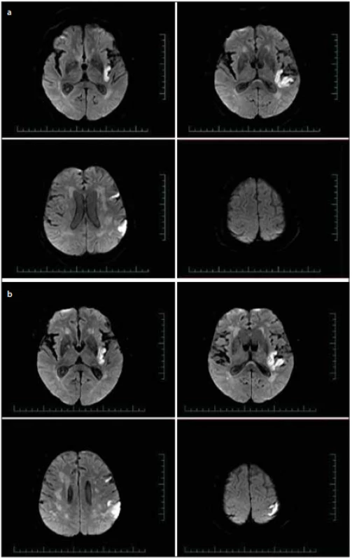 Difúziou vážená MR mozgu, b1000 – (a) predoperačný nález akútnej ischemie; 
(b) nález po zhoršení klinického stavu.<br>
Fig. 4. Brain MR diff usion weighted image, b1000 – (a) acute ischemia before surgery; 
(b) after clinical deterioration.