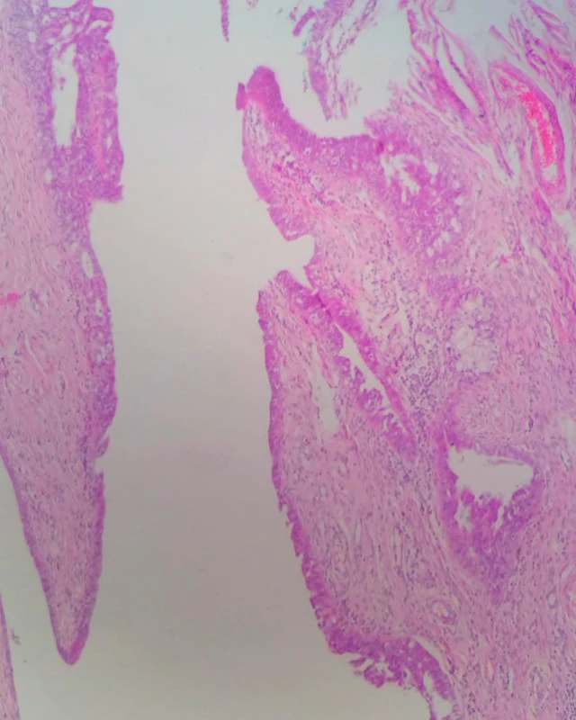 Fimbriae tubae uterinae so seróznym tubálnym intraepiteliálnym karcinómom (STIC); prítomná je stratifikácia jadier a cytologické atypie
